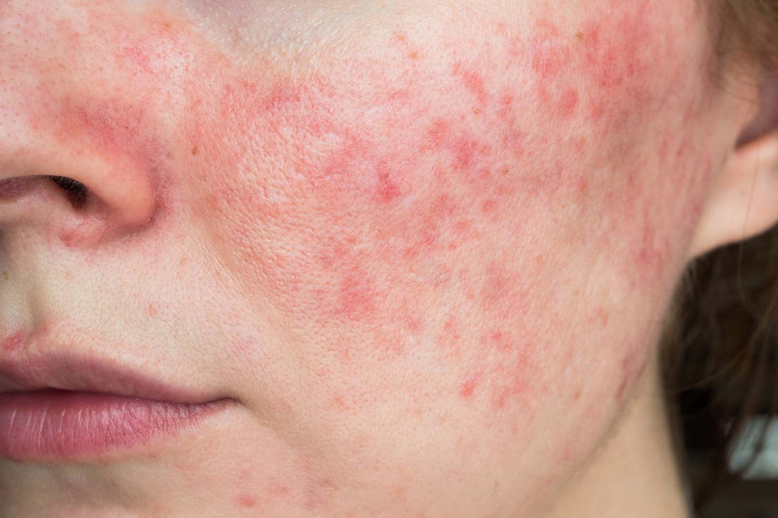 Wange einer Frau mit Rosacea