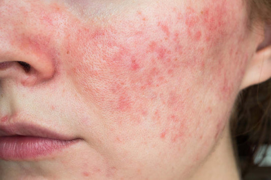 Wange einer Frau mit Rosacea